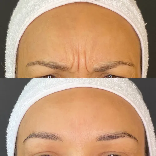 Botox (10)