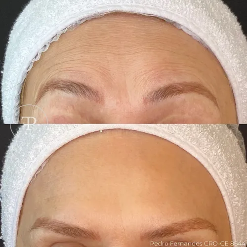 Botox (11)