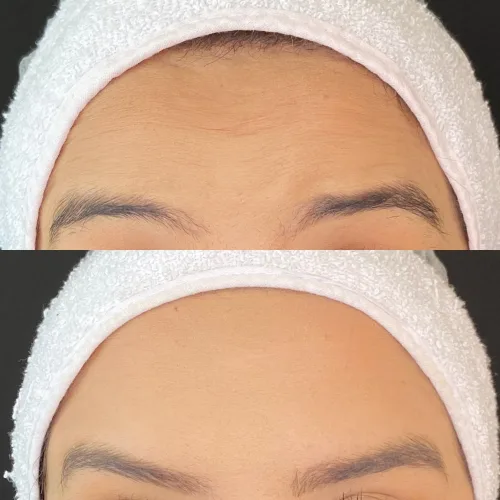 Botox (13)