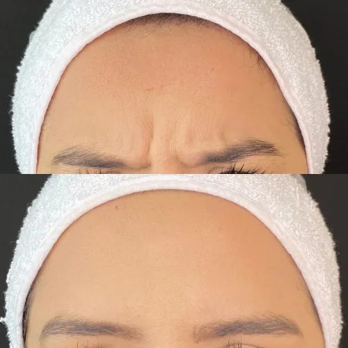 Botox (14)