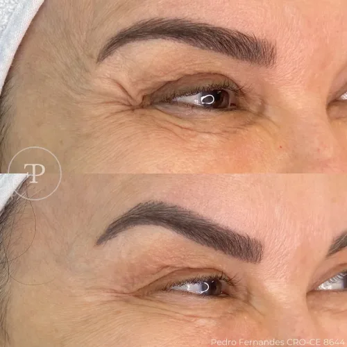 Botox (15)