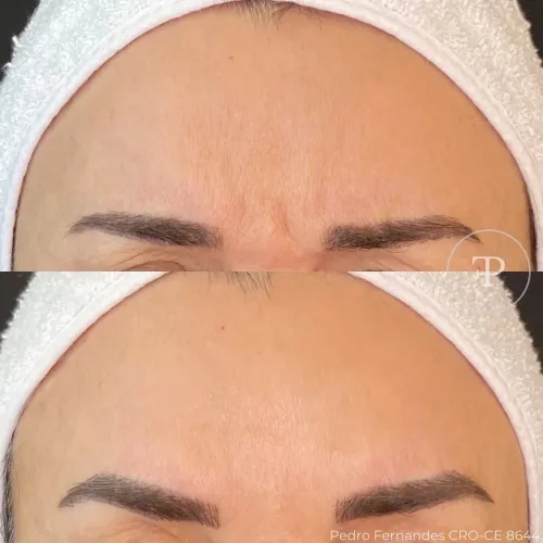 Botox (16)
