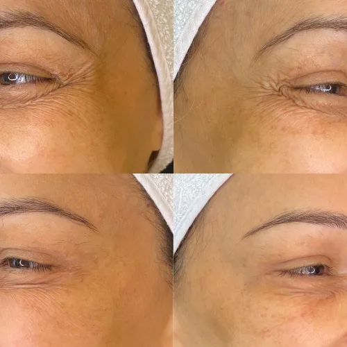 Botox (17)