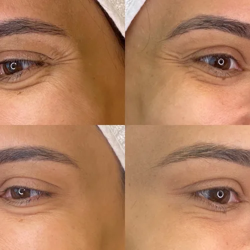 Botox (2)