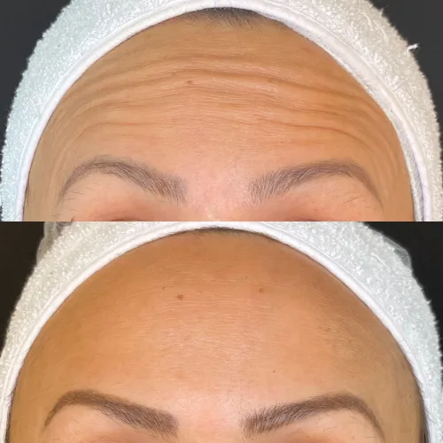 Botox (3)