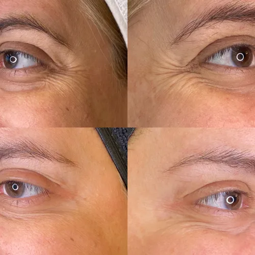 Botox (5)
