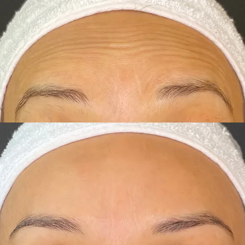 Botox (6)