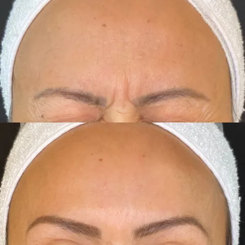 Botox (7)