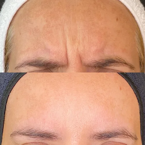 Botox (8)