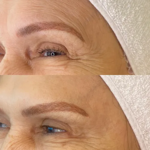 Botox (9)