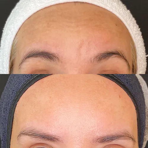 Botox