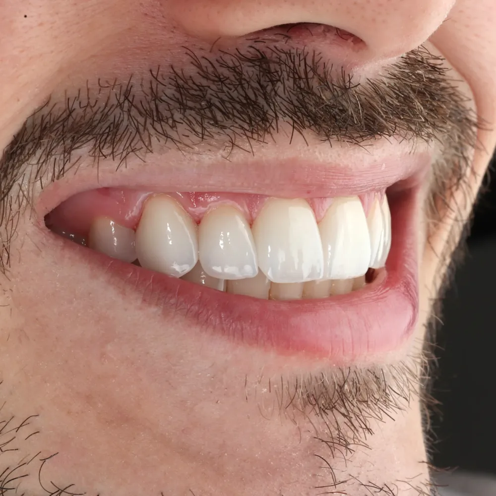 lente de contato dental lente de contato dental